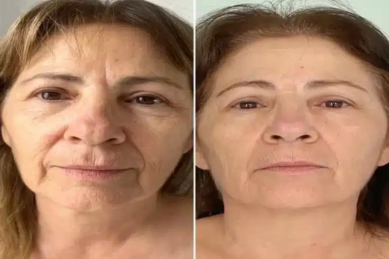HIFU vs. Traditional Facelift