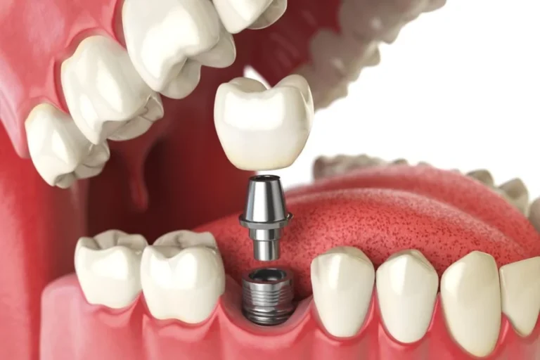 Signs You Need Dental Implants In Peabody Dental Implants
